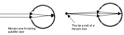 A myopic eye